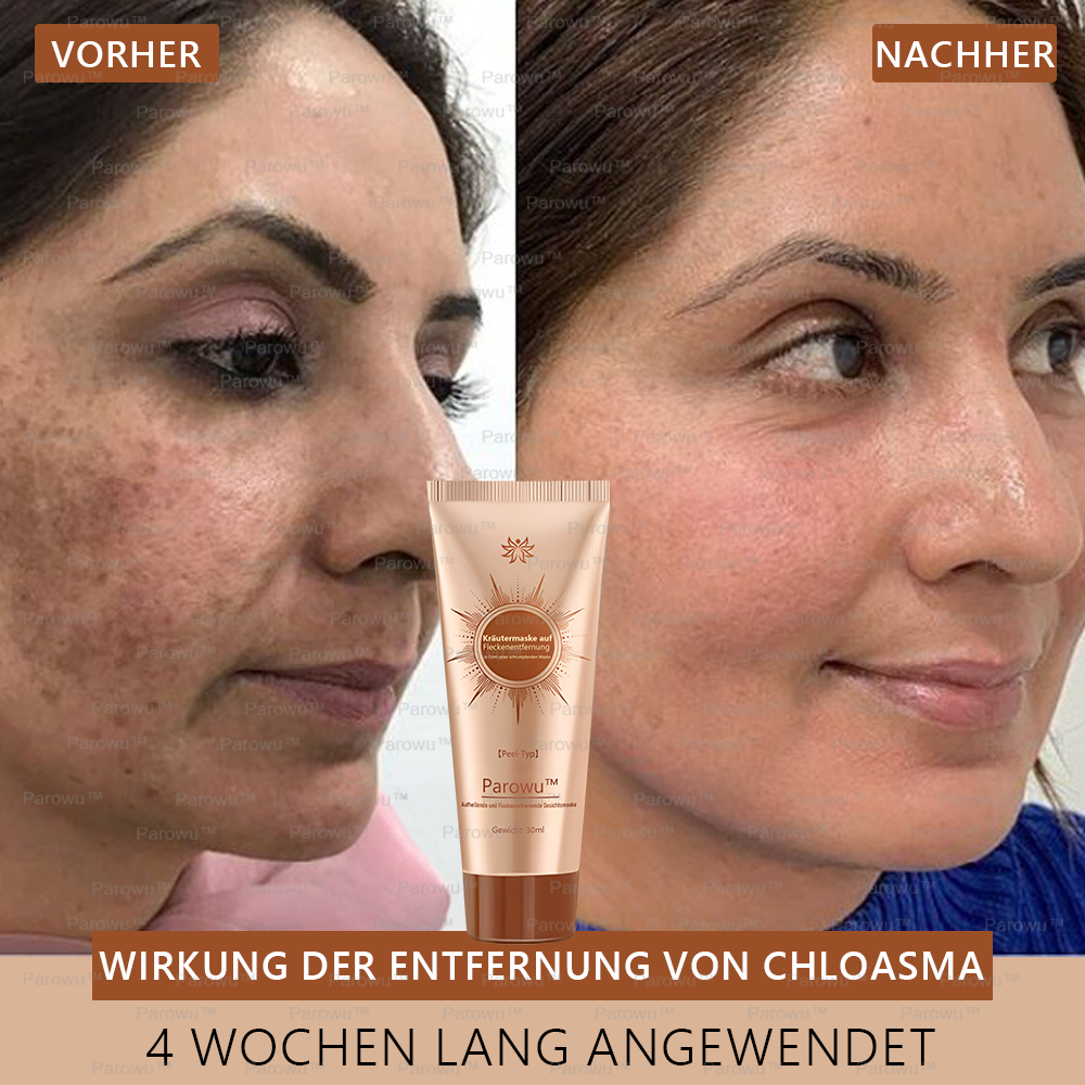 💟 Parowu™ Aufhellende und Fleckenentfernende Gesichtsmaske - Geeignet für Gesicht und Körper – 👩⚕️ Natürliche Inhaltsstoffe entfernen dauerhaft Altersflecken, Sommersprossen, Sonnenflecken und Leberflecken.